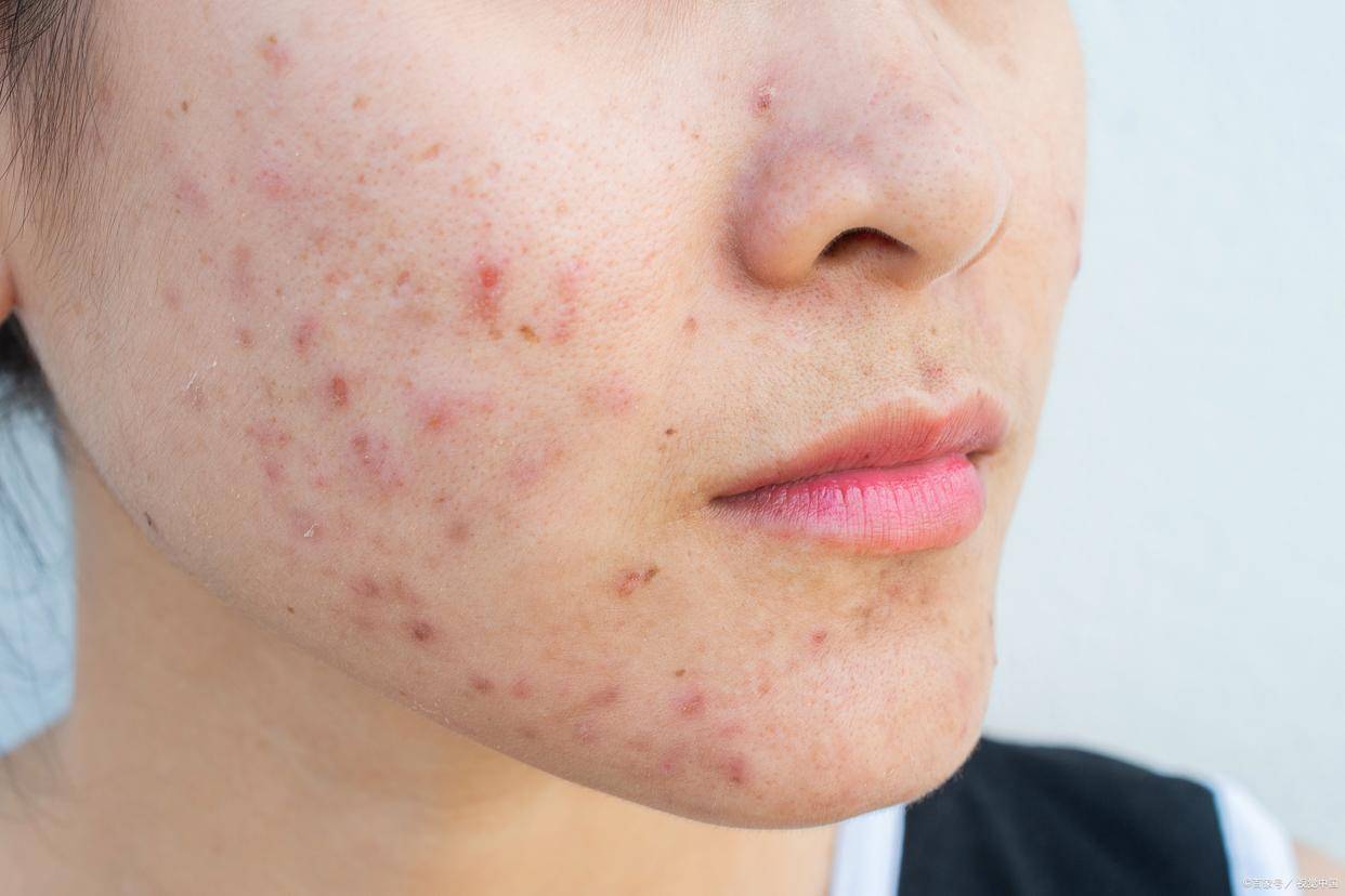 战痘宣颜揭开长痘的秘密