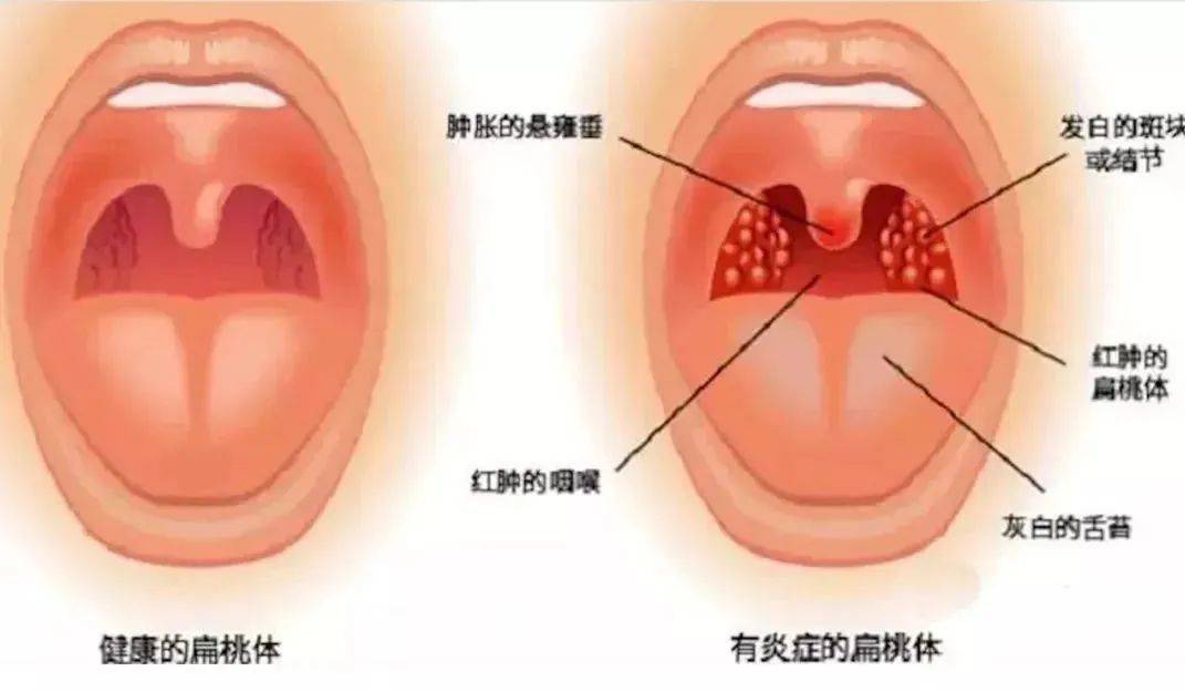 药王烙：高温酷热，还是扁桃体炎的“幕后推手”？(图1)