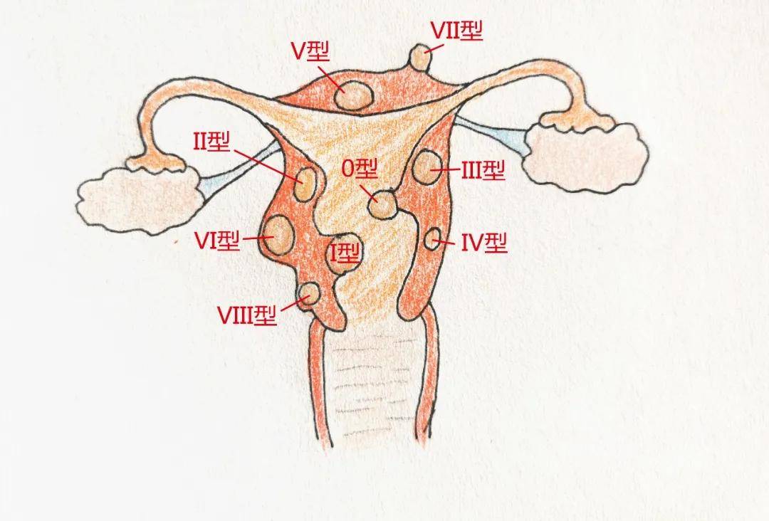 #学习分享442#子宫肌瘤手术有哪些？什么情况下需要进行手术？(图2)
