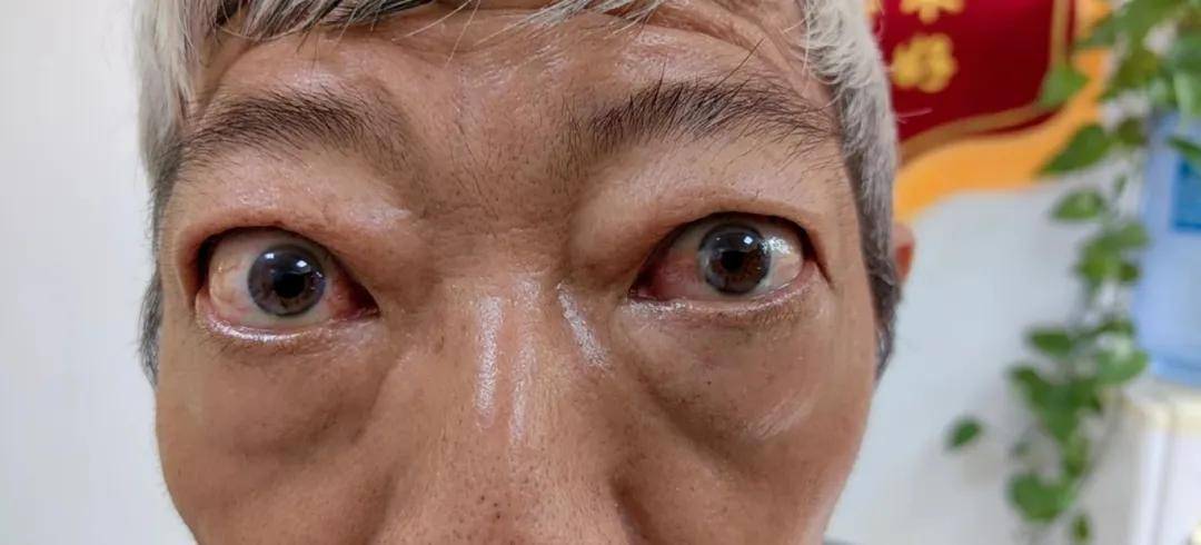 甲亢患者一定会发生突眼吗？哪些因素会导致甲亢突眼？看看中研医院医生解答(图2)