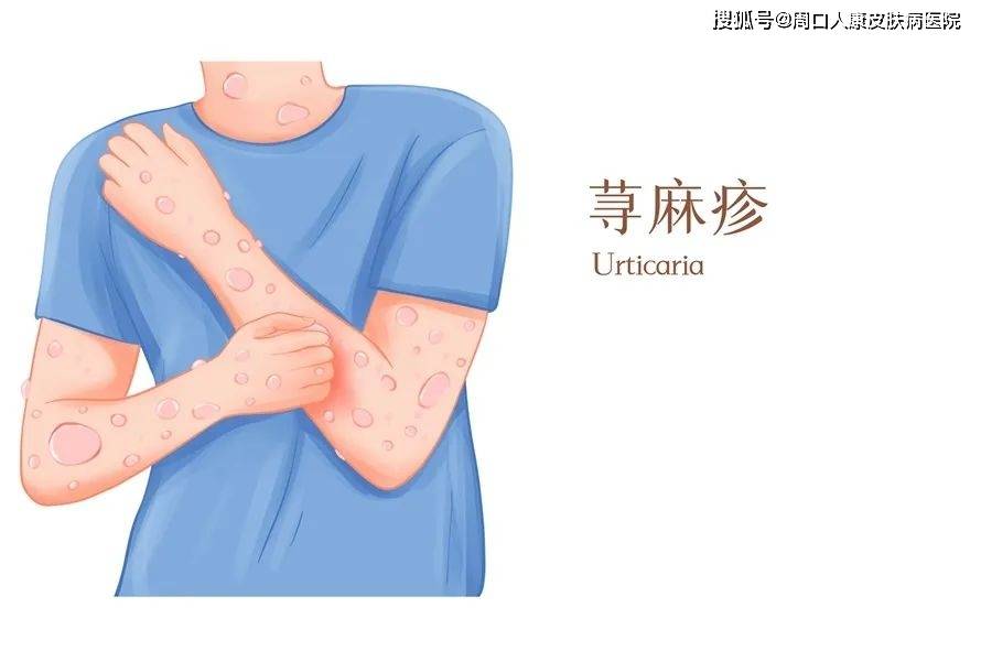 【周口人康皮肤病医院】儿童荨麻疹为何如此磨人？