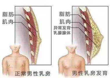 男性乳腺发育的原因(图1)