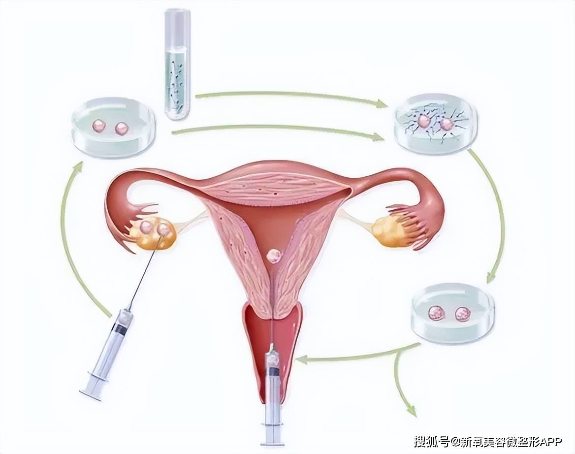 在取卵前2天，医生会对患者每天进行一次阴道冲洗，以减少术中感染风险。
