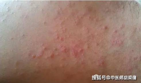 内服清热利湿中药是中医治湿疹的主要方法