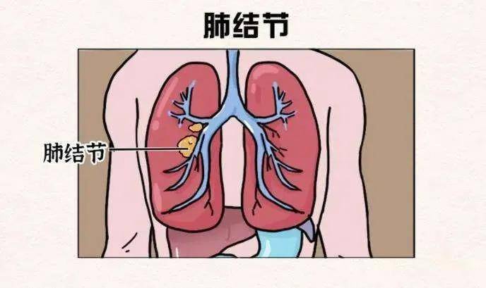 再顽固的肺结节,也怕3个药,清肺散结,止咳化痰,结节散的干净