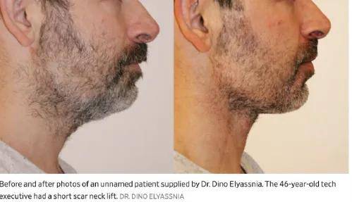 原创             996卷成002后,硅谷科技男为不被裁员扎堆做医美……