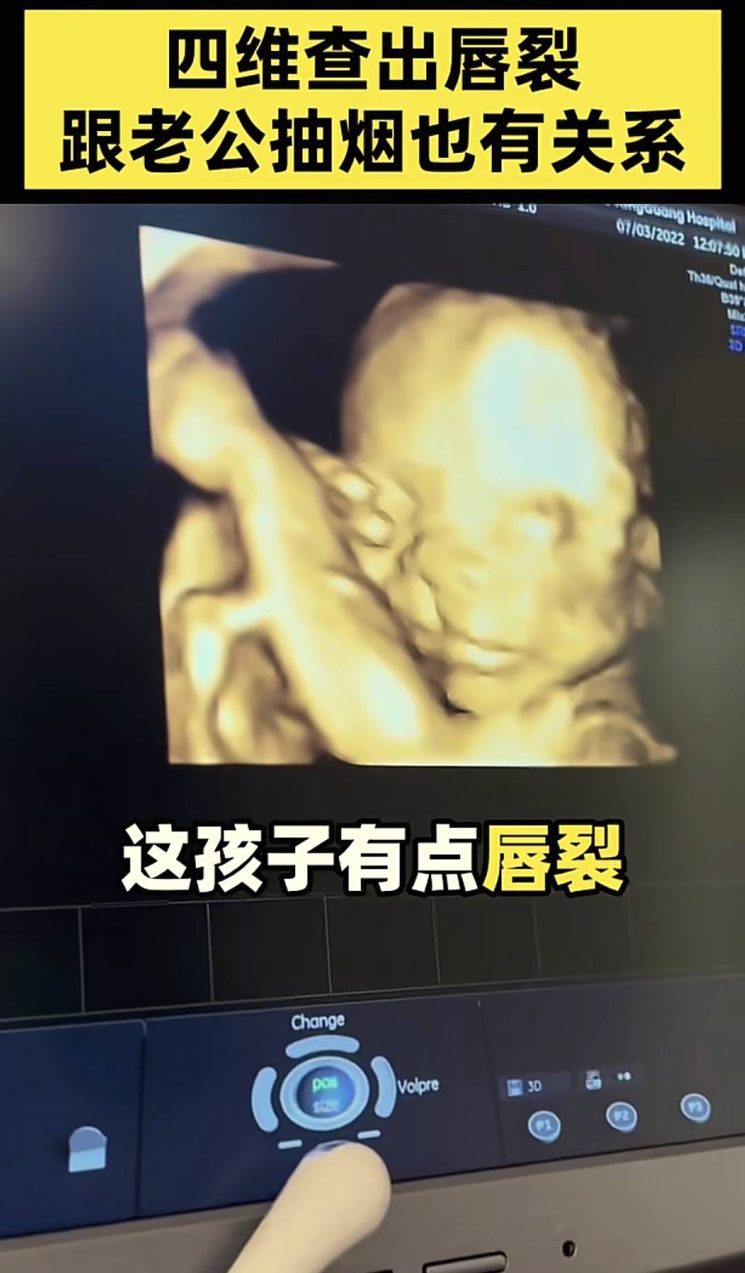 男人抽烟对家庭伤害多大?老婆流产,女儿肺癌,儿子身高少10厘米