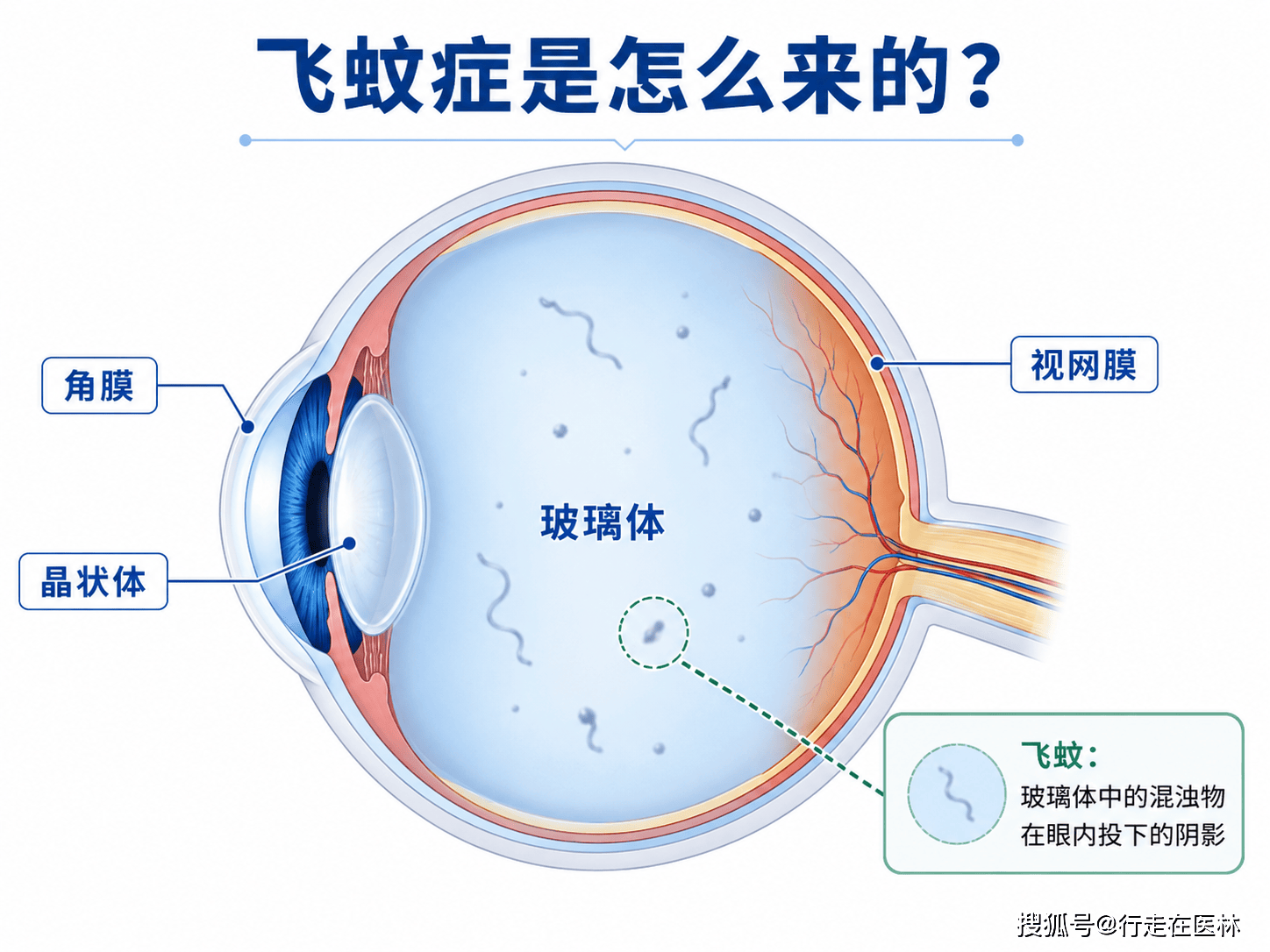 眼前飘动的黑影突然增多，什么情况需要去看