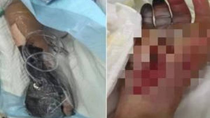 大爷清洗海鱼时被扎,24小时进icu,是意外吗?