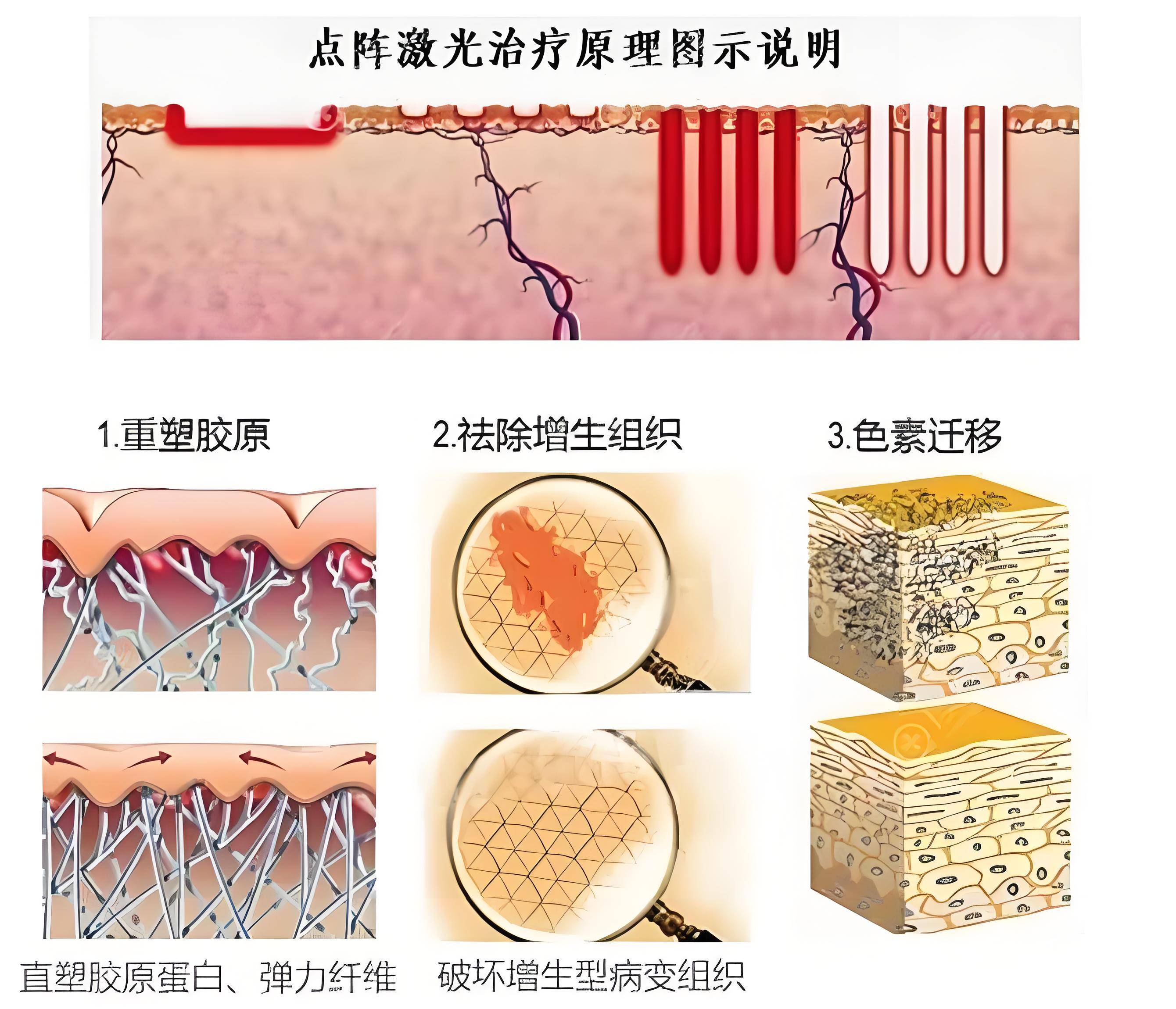 米乐M6网站面部抗衰张武大夫解析：常睹的医美光电项目有哪些？(图2)