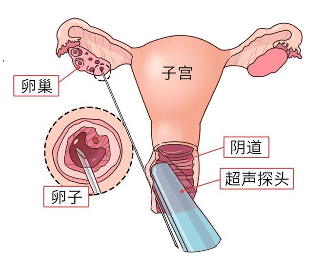 广州供卵技术与性别选择的科学分析