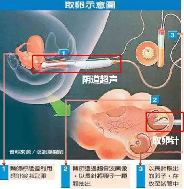 深圳供卵试管技术的发展与挑战：助力不孕不育家庭实现生育梦想