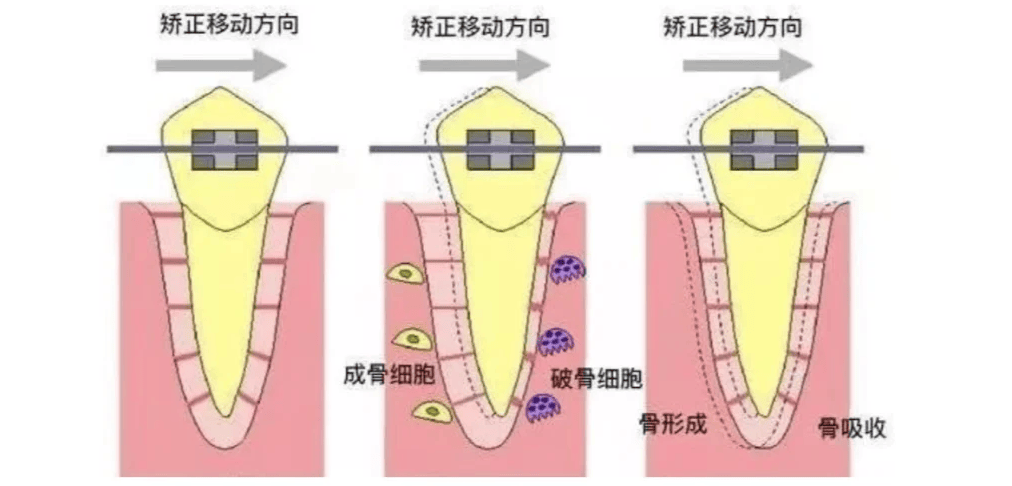 邢台正畸专家：矫正牙齿会不会造成牙齿松动？(图3)