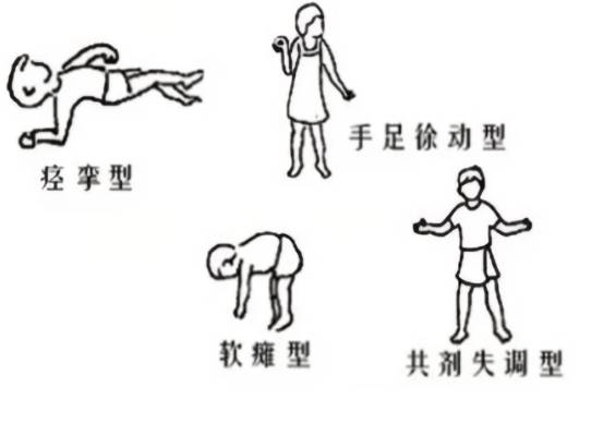 一文读懂脑性瘫痪分型​