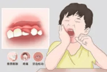 河南5岁儿童患牙瘤 手术取出几十颗异常牙齿