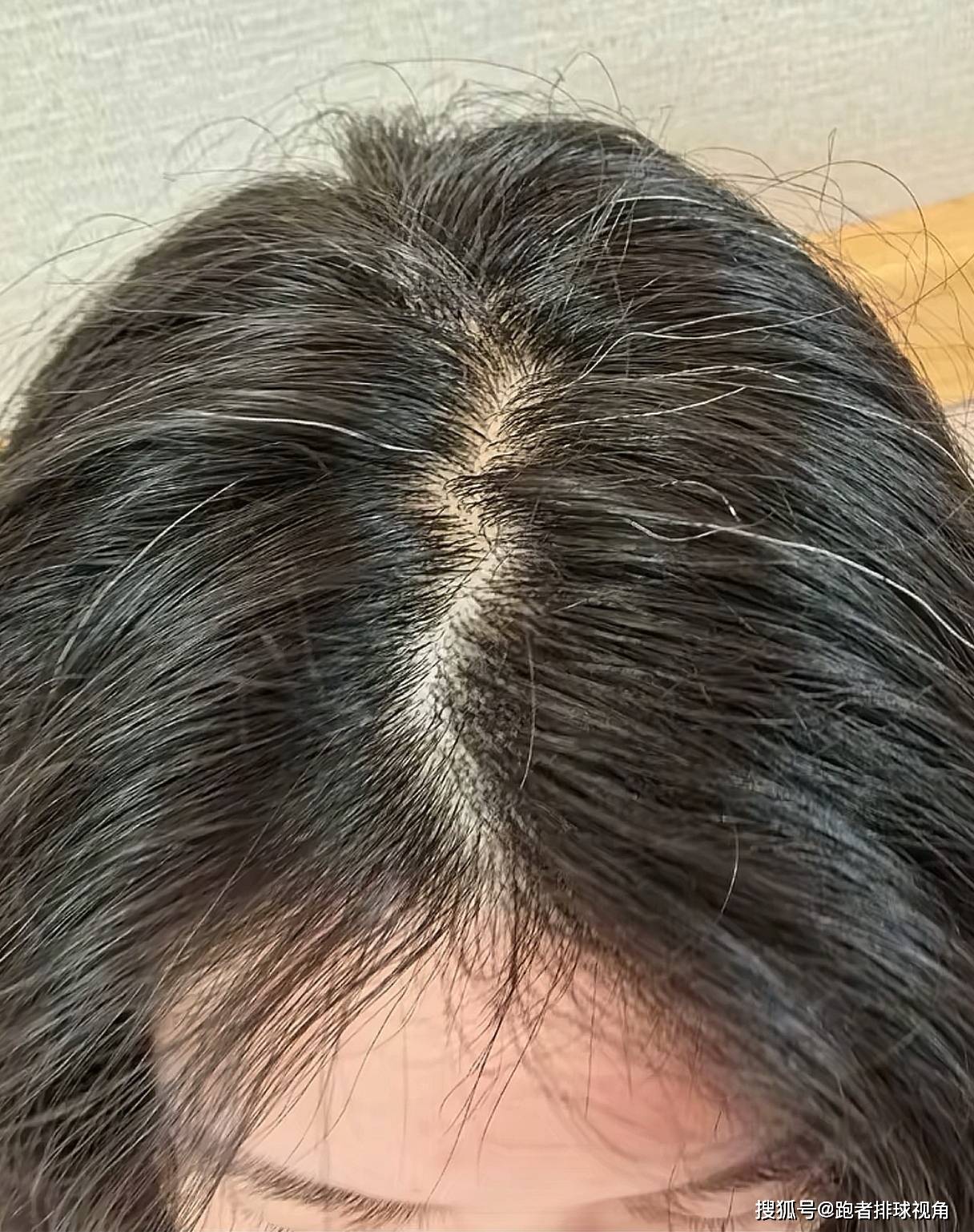 原创             李盈莹发布康复过程！手术照首次公开，白头发抢眼，状态已超预期