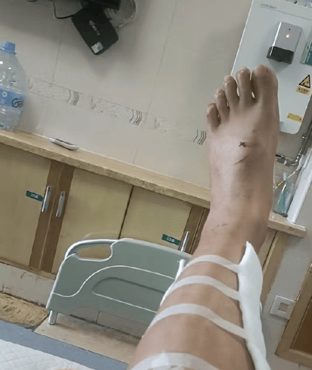 史上最狠老哥，脚扎钉子不处理，硬扛近两年