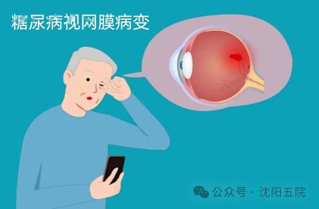 警惕恐怖的视力杀手——糖尿病视网膜病变