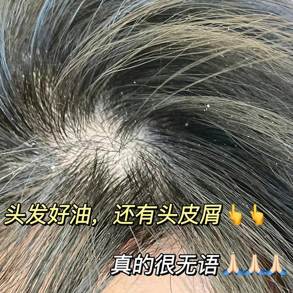 头发头皮屑特别多还痒怎么办？去除头屑的洗发水推荐