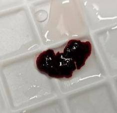 输液时抽出“虾线”状血条！？我还有救吗……