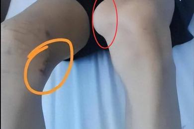 17岁体育生左膝长骨瘤医生错切右膝：如此离谱