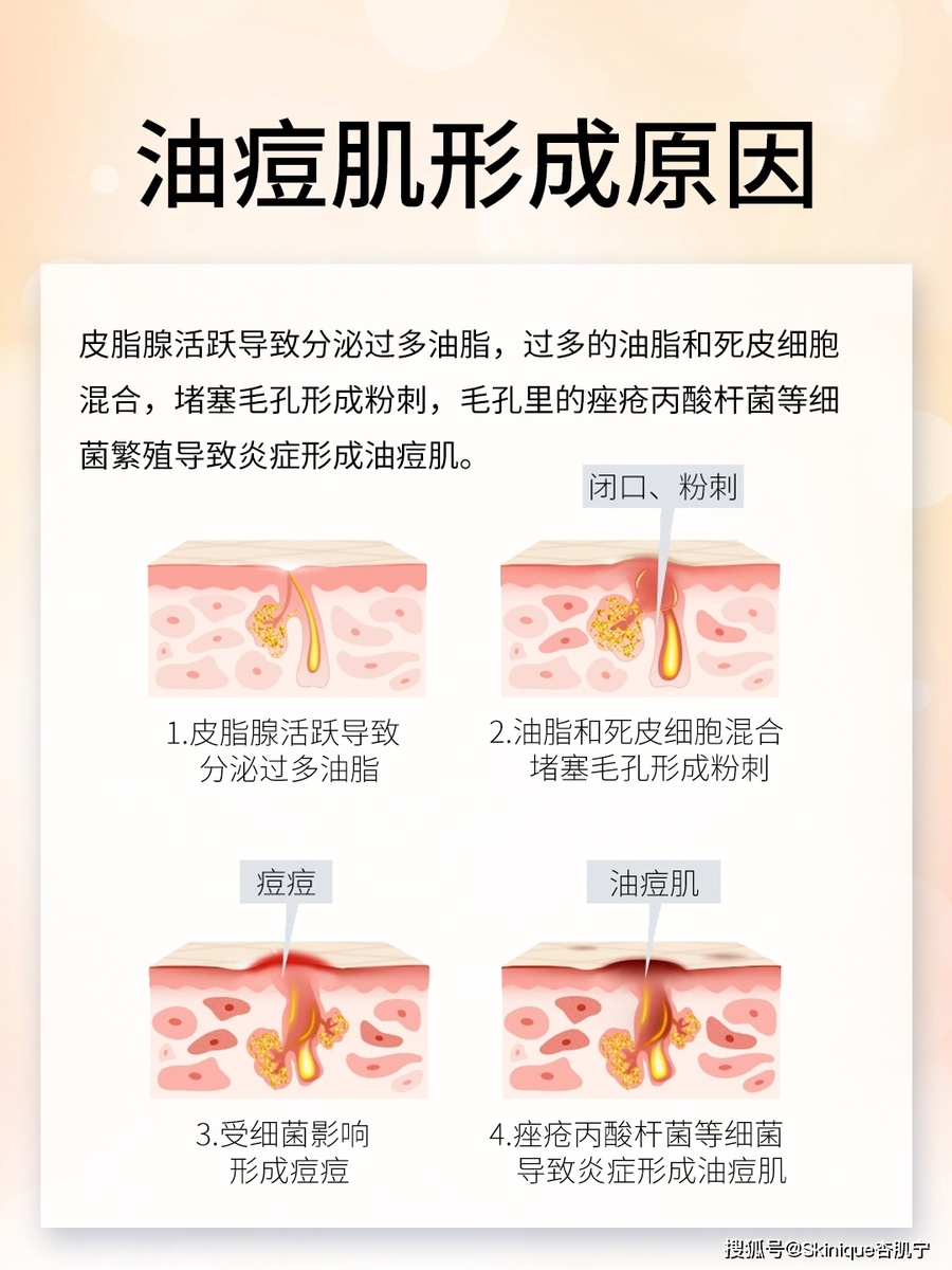 油痘肌VS油敏肌：你的皮肤属于哪一派？