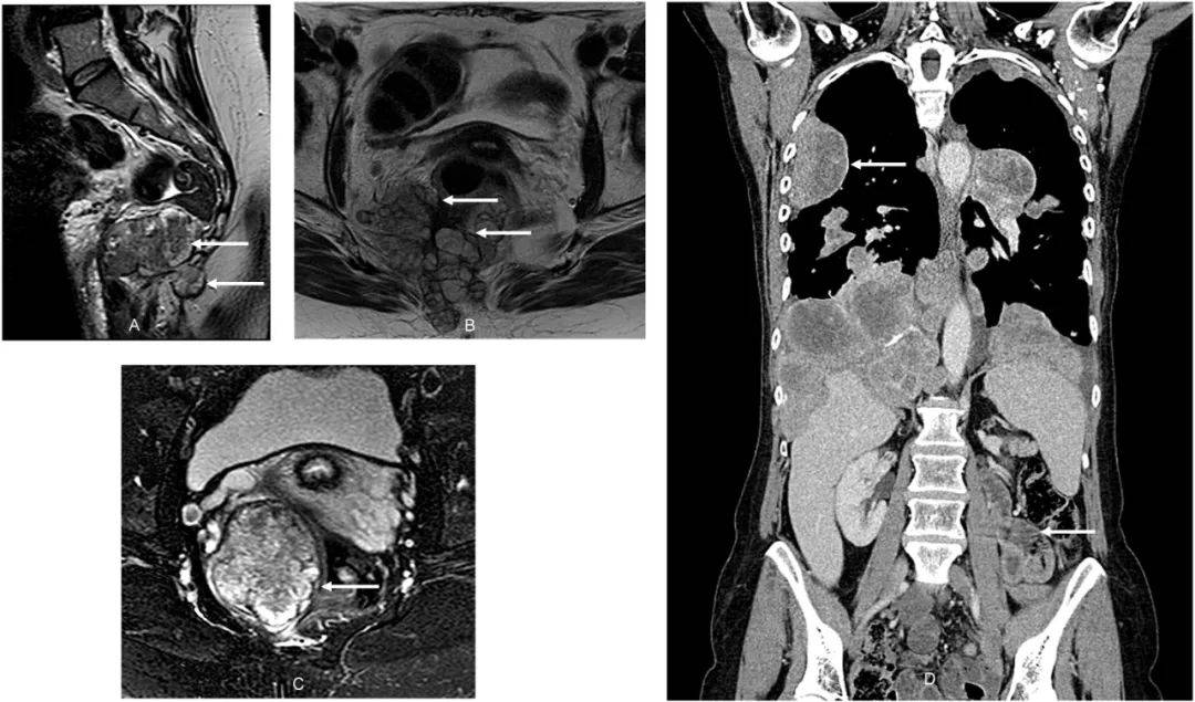 二十年前,患者確診為累及硬膜內終絲的盆腔mpe,磁共