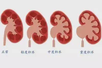 光邦光子治療儀:前列腺增生8大危害,中老年大叔要小心,千萬別大意