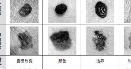 看深度:智能否癌变和大小无关,和深度有关,而深度取决于痣细胞的位置