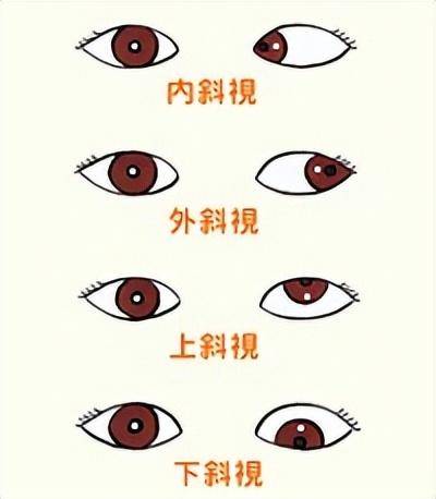 儿童斜视预防方法