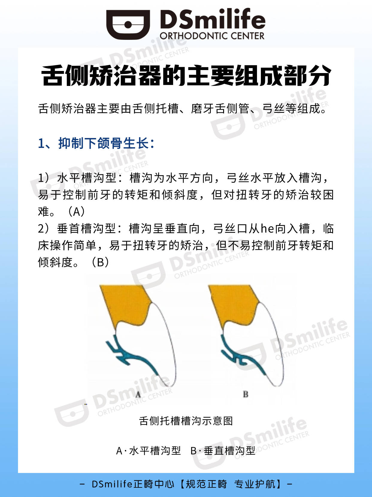 ds正畸|舌側矯治器的主要組成部分_槽溝_臨床_前牙