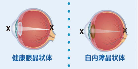 如果把眼睛比作照相机,晶状体就像镜头,起到聚光,成像的作用