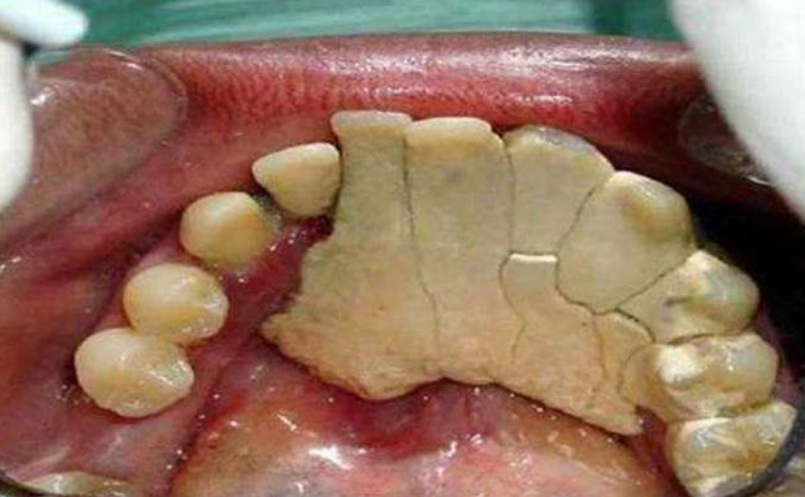 满嘴牙结石又臭又硬?过来人3招教你解决!不花一分冤枉钱!