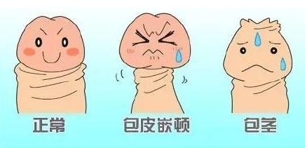 上海程开祥教授:房事别太猛,当心丁丁发生这些事故_包皮_方法_进行