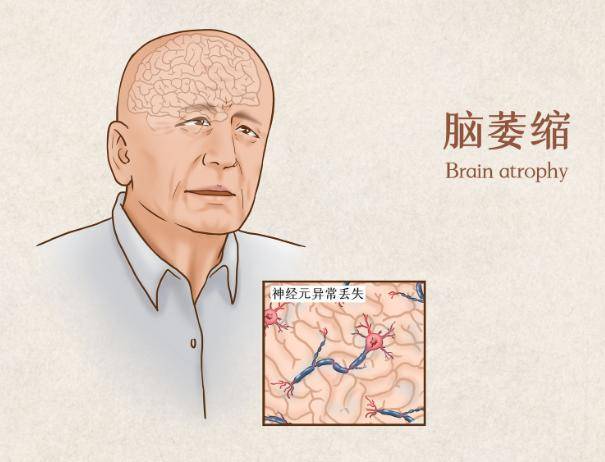 萎缩,一般出现3个反应,多吃4种健脑食物,辅助降低风险_患者_症状_发展
