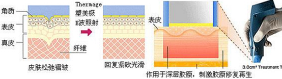 真相大白:超聲刀線雕哪個更好,超聲刀和線雕哪個效果?