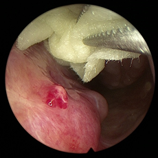 •发现并从孩子的鼻子里取出异物•获得鼻腔,鼻窦,鼻咽分泌物培养