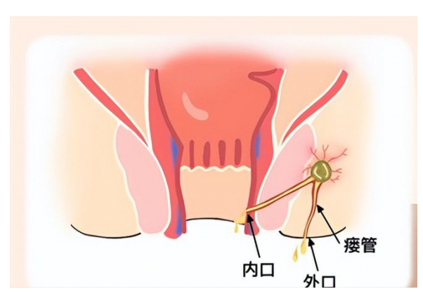 这种情况可能是肛瘘,治错老遭罪了!