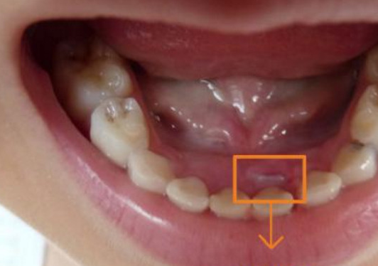 孩子乳牙不脱落长出了双排牙 作为家长的你知道是什么原因吗_牙齿