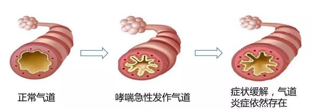 慢性支氣管炎的危害有哪些?_疾病_呼吸道_炎症