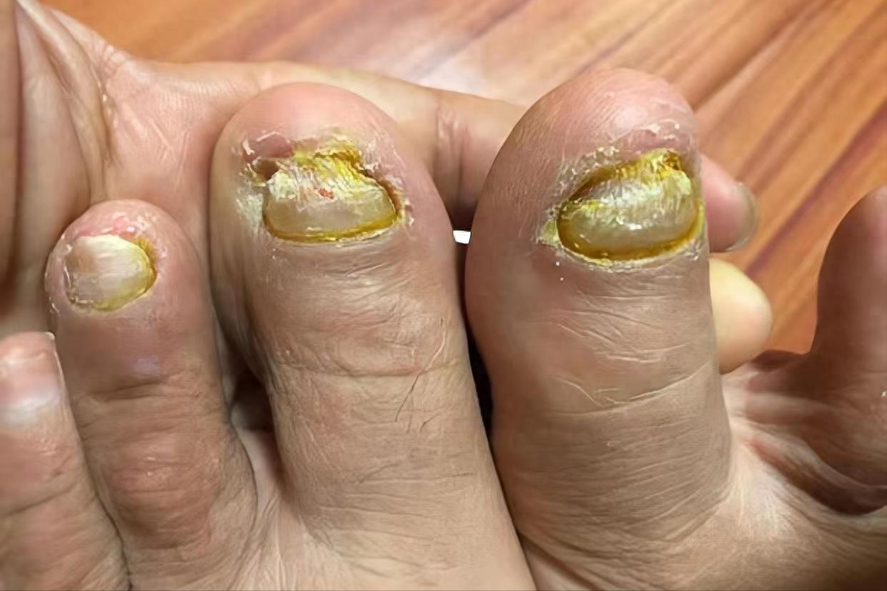 碘伏治灰指甲很神奇!搭配好方法轻松搞定不复发!亲测管用!