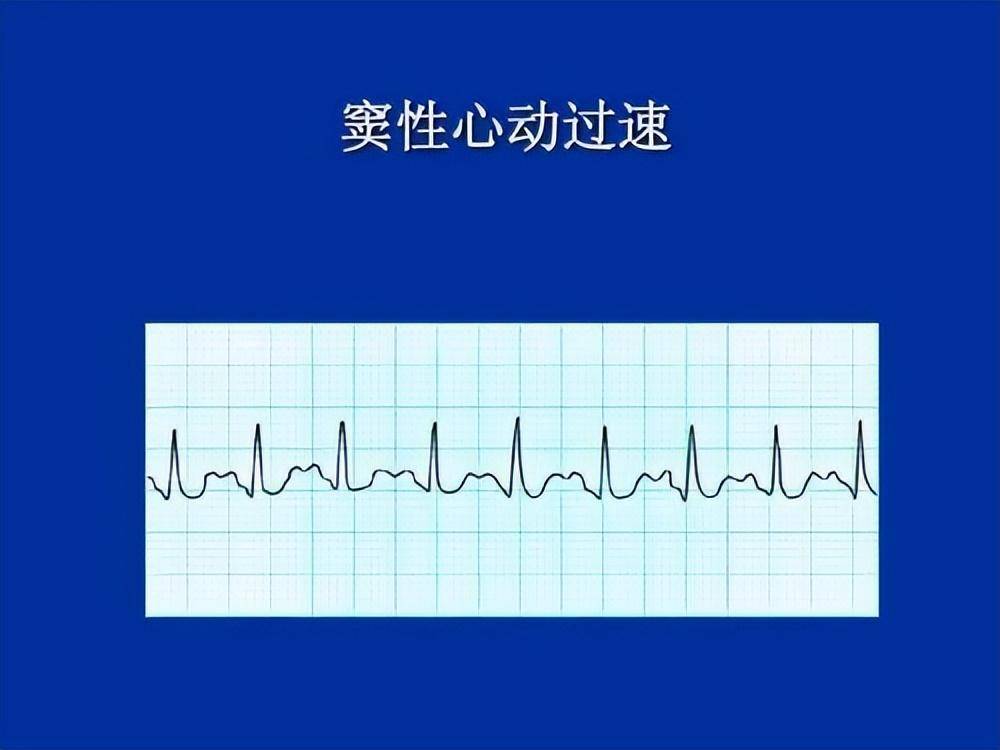 总听到窦性心律到底是什么?窦性心律不齐是大病吗?