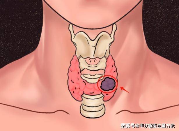 甲状腺结甲结节 来自搜狐网
