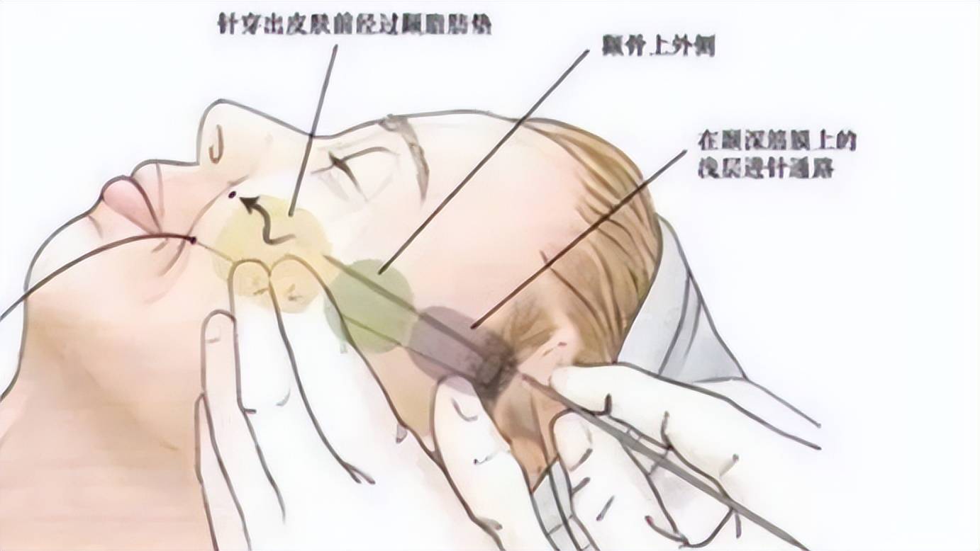 實錘真相了~)線雕提升原理做蛋白線提升面部,線體進入體內,遇到體液後