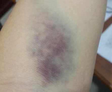 击打精准度差等问题,使用后难免会引发肌肉酸痛,肌肉肿胀,淤青等问题