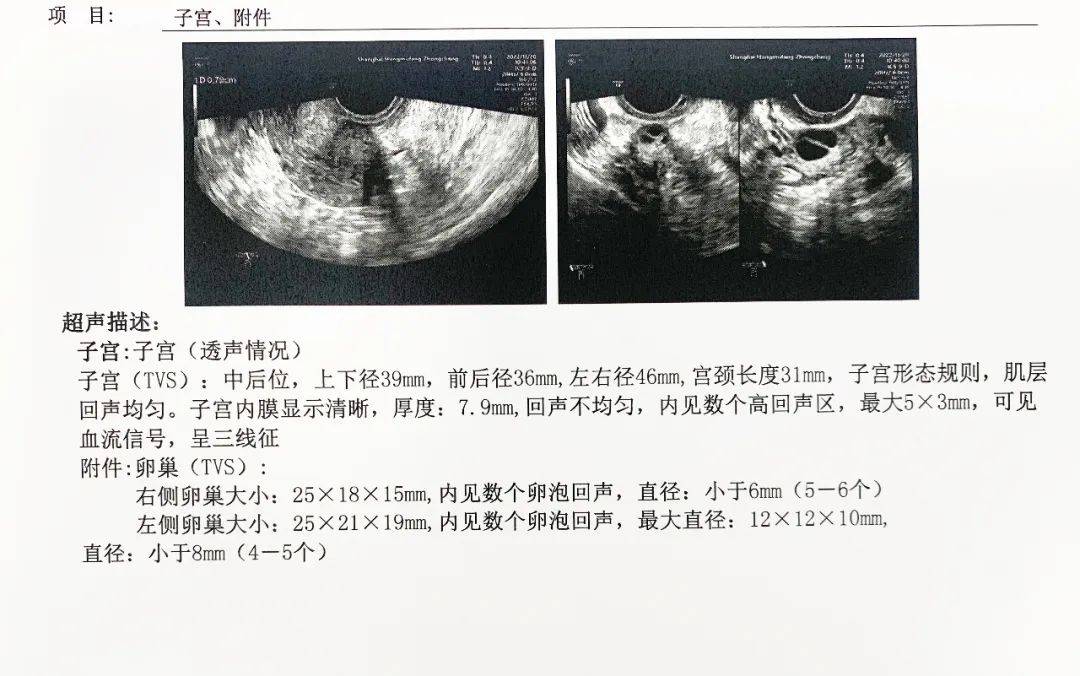 通过b超可以清晰观测到卵巢的体积大小和卵巢内的窦卵泡数量,从而能