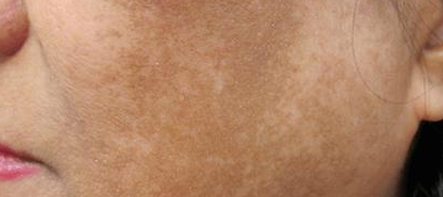 褐色斑块叫什么皮肤病图片