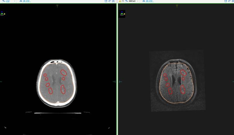 智慧腦放療技術為肺癌多發腦轉移患者