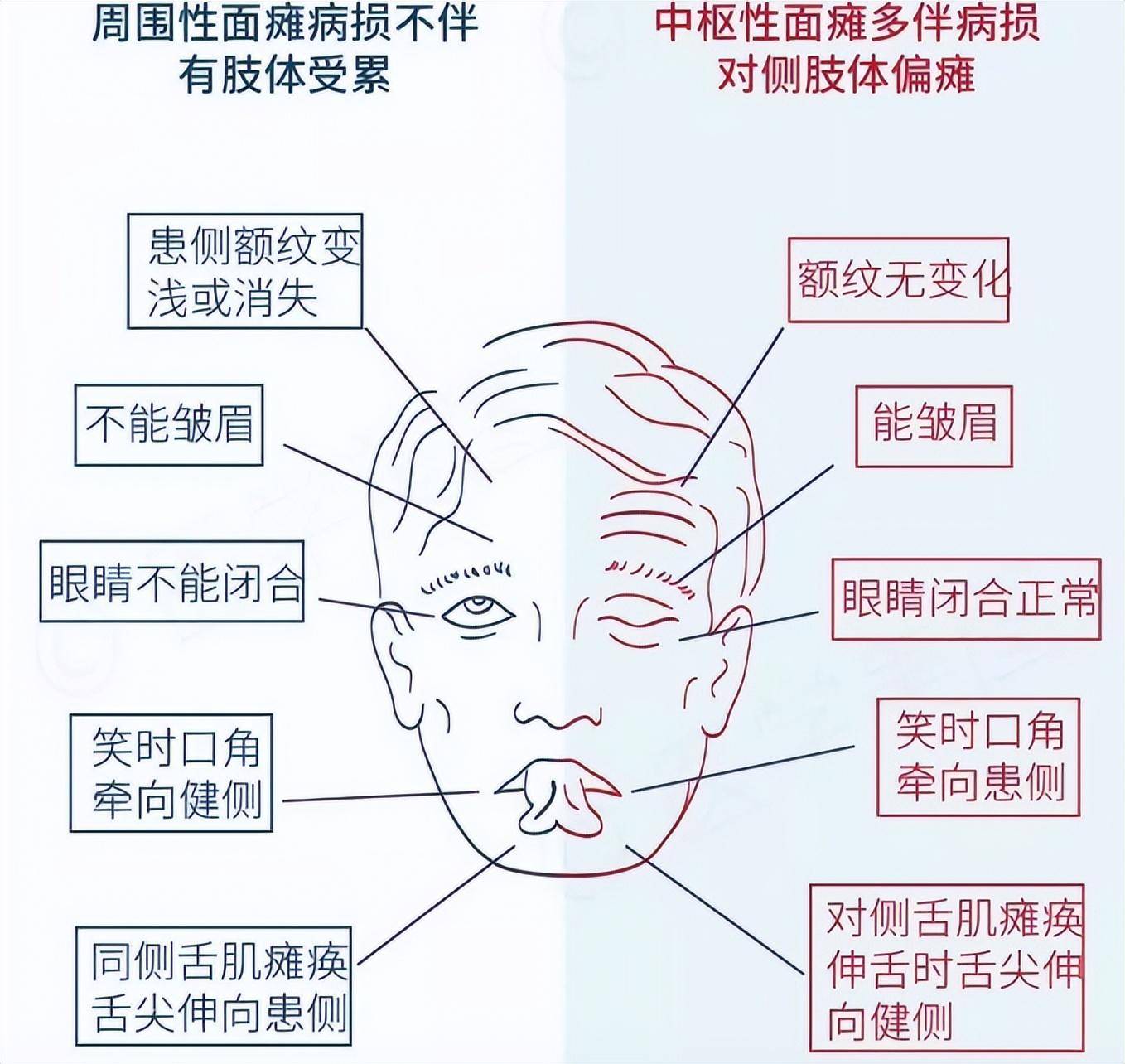 根据面神经损伤部位的不同