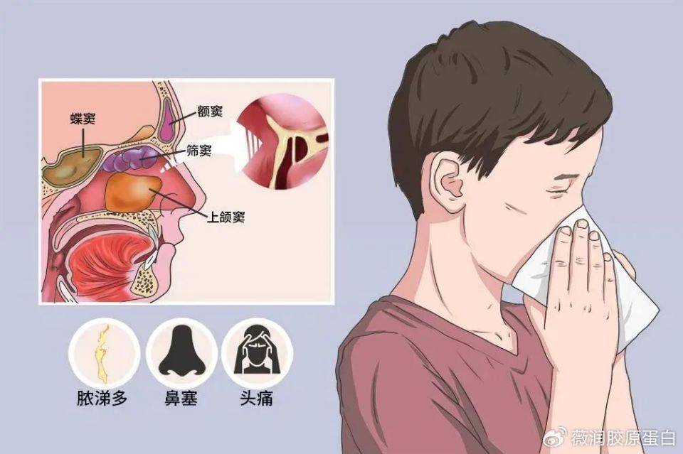 鼻炎(rhinitis)指的是鼻腔粘膜和粘膜下組織的炎症.